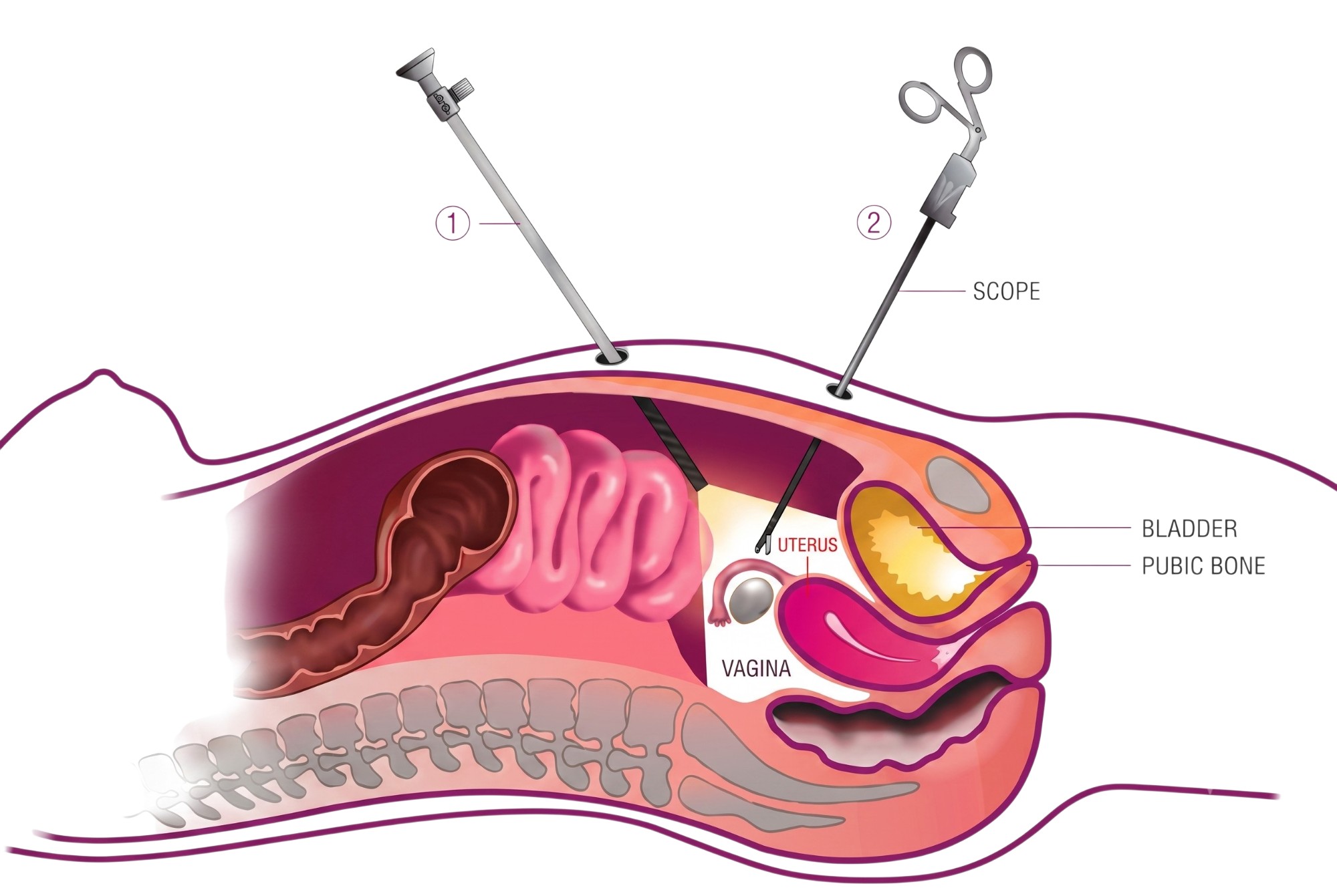 Laparoscopic (Minimally Invasive) Gynecological Surgery