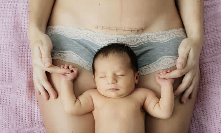 Vaginal Birth After Cesarean (VBAC)