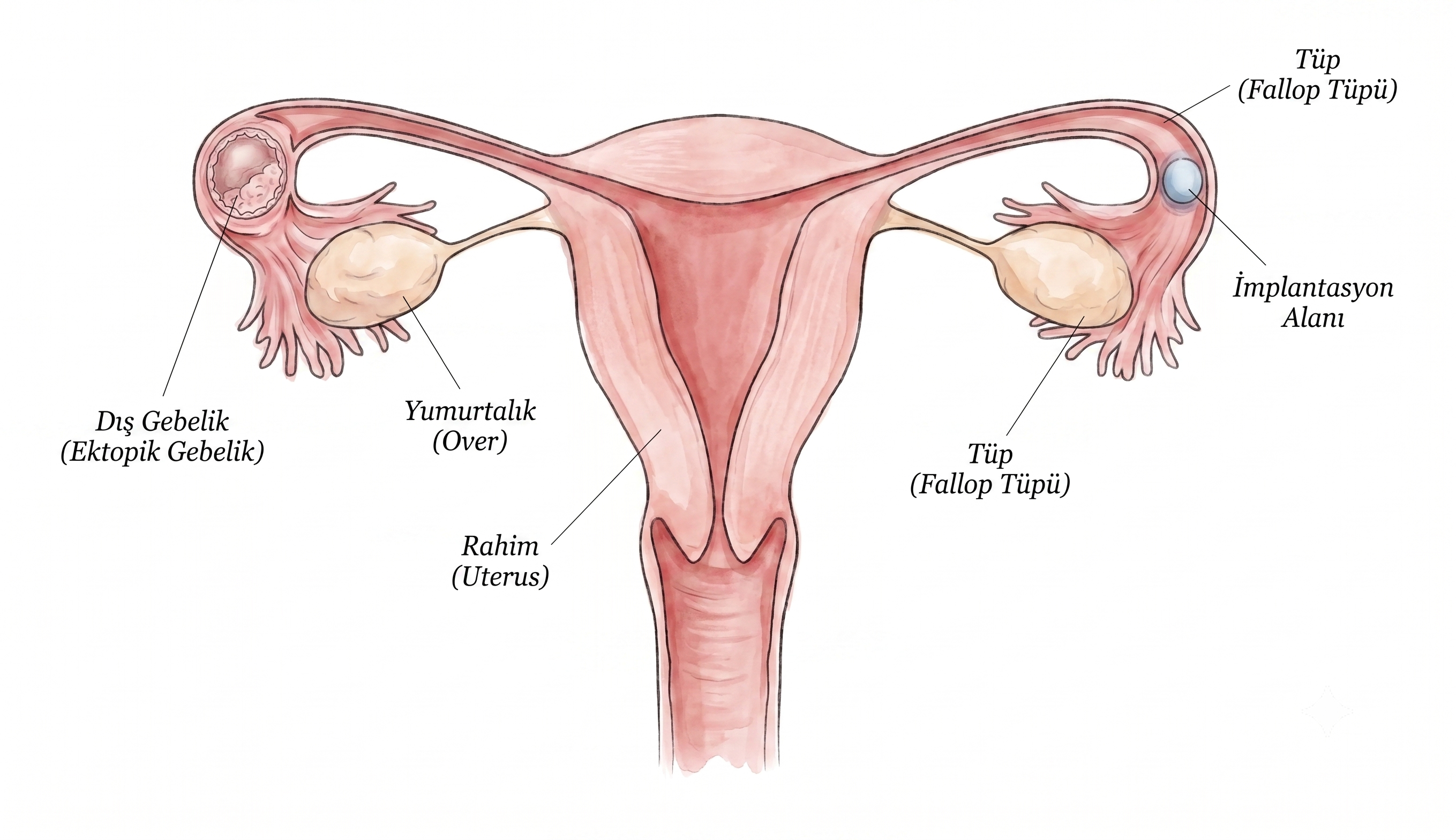 Ectopic Pregnancy (Extrauterine Pregnancy) Diagnosis and Treatment