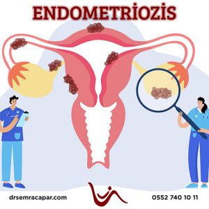 endometriozis