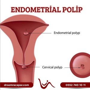 endometrial polip